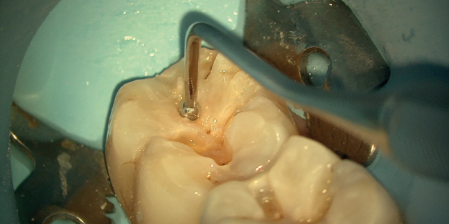 Cavity restoration with Augmented Visualization Modes on ZEISS EXTARO 300